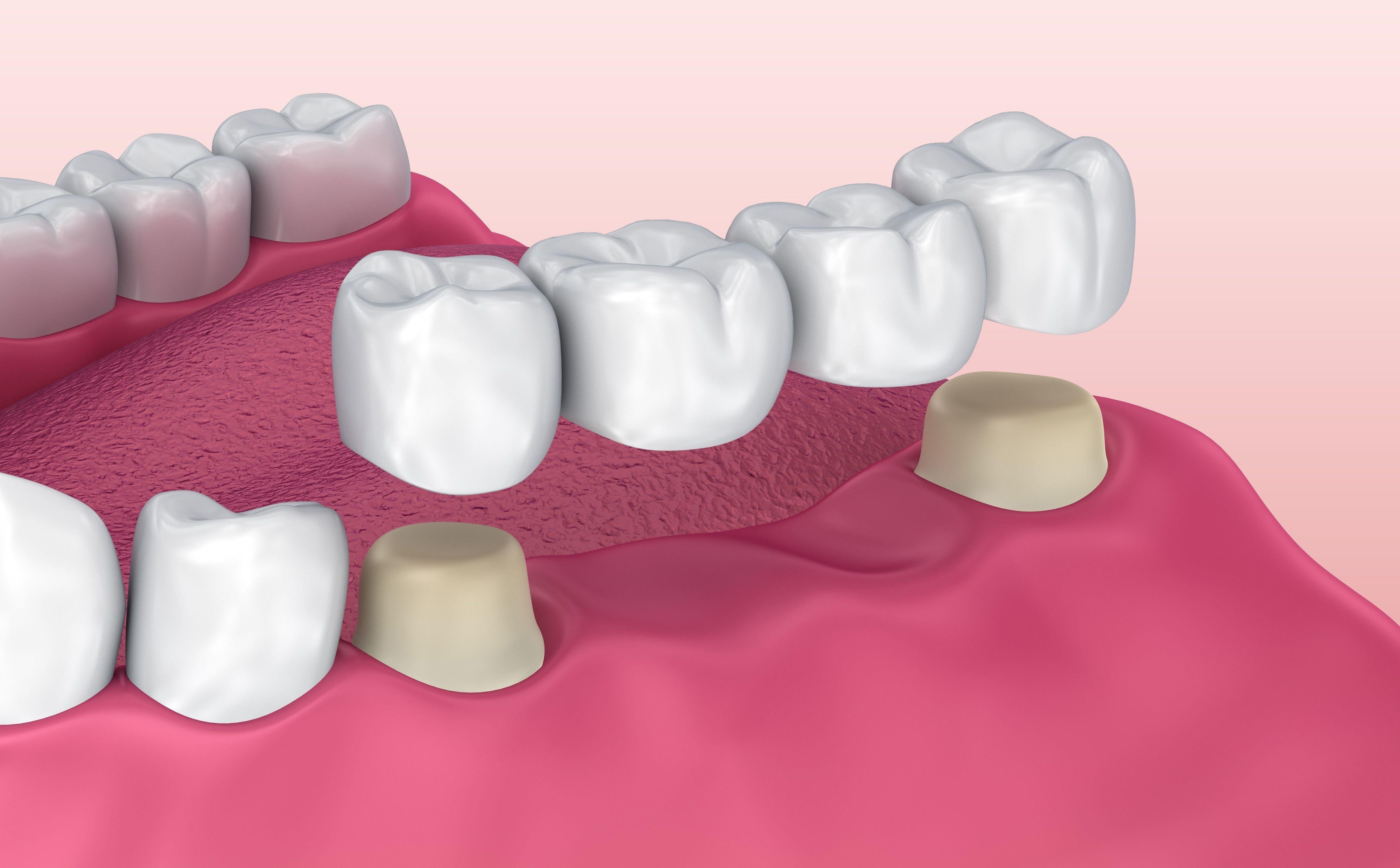 Tooth Bridge