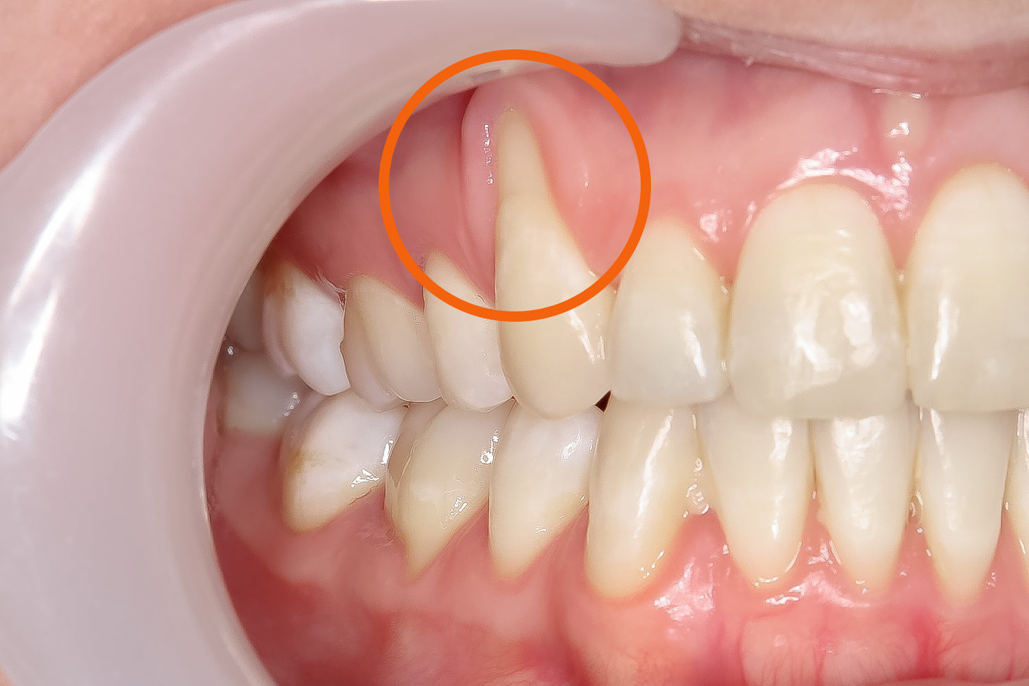 How Do You Prevent Receding Gums? A Complete Guide to Healthier Smiles